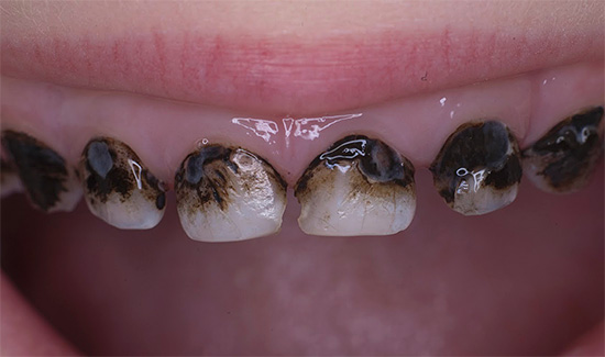Viene mostrato un esempio di denti dopo l'argentatura: devi concordare sul fatto che non sembrano molto belli.