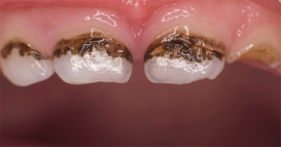 Denti argentati