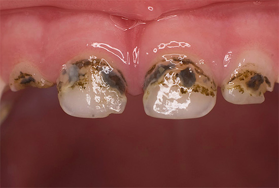 In generale, si può notare che l'efficacia dell'argentatura dei denti per prevenire lo sviluppo della carie è piuttosto dubbia.