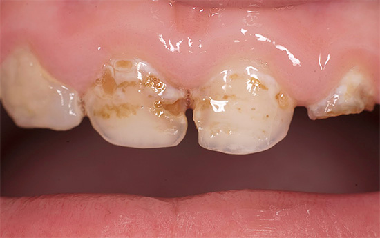 E questo è un processo carioso più profondo: lo smalto dei denti viene completamente distrutto in alcuni punti.