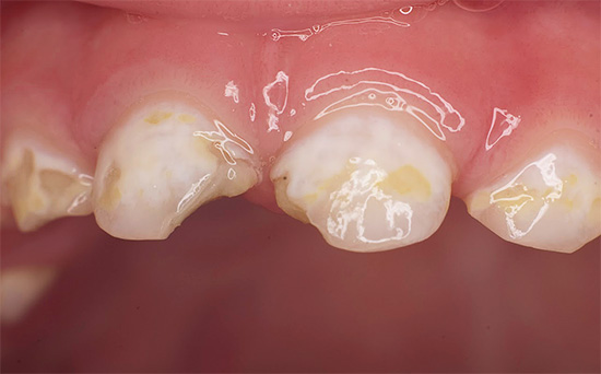 Carie in bottiglia di denti decidui prima del trattamento