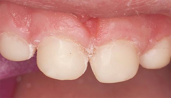 E così sembrano gli stessi denti, ma dopo il trattamento.