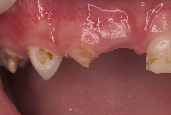 La forma trascurata di carie in bottiglia in un bambino è spesso colpa dei suoi genitori, che, attraverso la loro inazione, hanno portato a una situazione del genere.