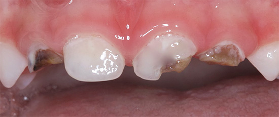 Nella fase avanzata dello sviluppo della carie in bottiglia, una parte significativa dello smalto e della dentina del dente viene completamente distrutta.