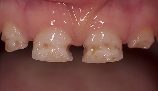 La carie acuta si sviluppa più spesso nei bambini con denti da latte