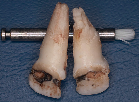 In alcuni casi trascurati, i singoli denti non possono più essere salvati e devono essere rimossi.