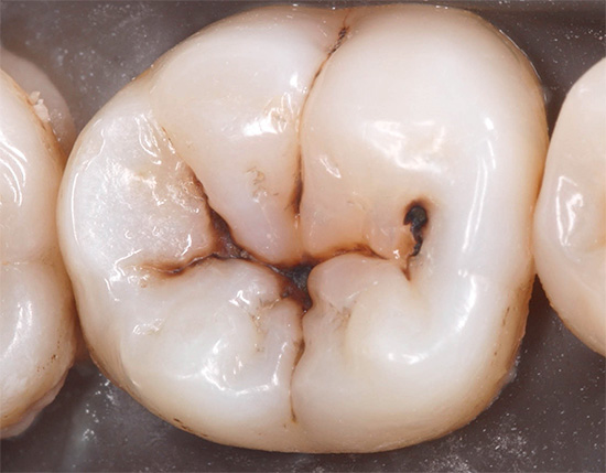 Considera le caratteristiche della carie delle fessure, inclusi i principali metodi di diagnosi e trattamento.