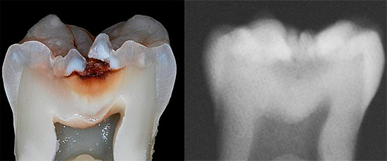 Una radiografia può rilevare la carie nell'area della fessura solo nelle fasi successive, quando il tessuto dentale è già gravemente danneggiato.