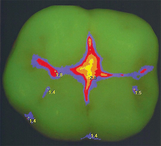 Uno dei metodi moderni molto efficaci per rilevare la carie delle fessure è la diagnostica laser.