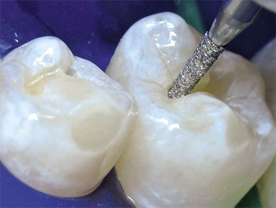 La fissurotomia viene utilizzata per determinare la profondità delle lesioni cariate.
