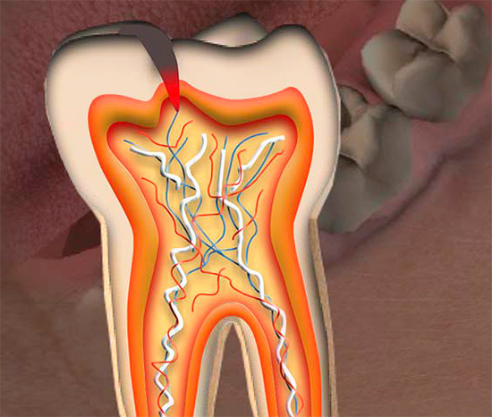 Se la carie delle fessure ha raggiunto la camera della polpa, nella maggior parte dei casi sarà necessaria la rimozione del nervo dentale.