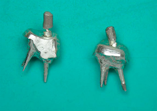 Linguette del moncone dentale
