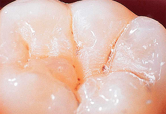 Nella maggior parte dei casi, la carie delle fessure si sviluppa in modo asintomatico, anche se guardandoti allo specchio puoi già vedere le aree oscurate sui denti.