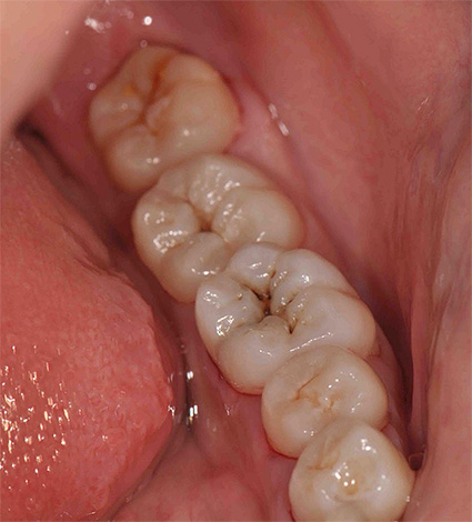 Spesso la carie delle fessure è facile da rilevare anche con un semplice esame visivo dei denti.