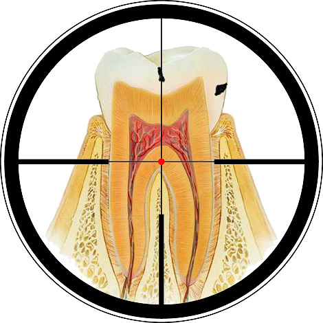 Nonostante il gran numero di cliniche dentali oggi, molte persone stanno ancora cercando di sbarazzarsi della carie a casa da sole. Parleremo ulteriormente se questo è possibile ...