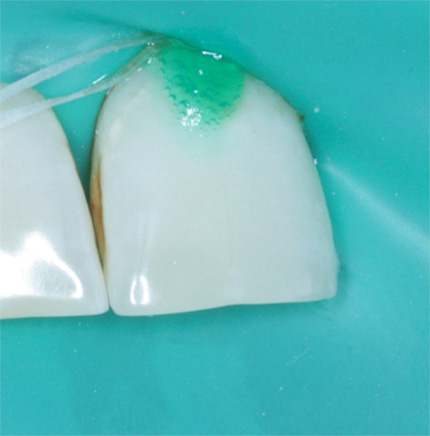 Il dente viene isolato dalla cavità orale usando una diga di gomma, l'ICONA viene applicata sullo smalto.