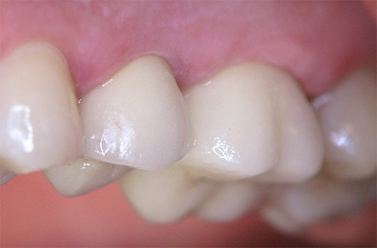 Con un'adeguata prevenzione della carie a casa, è possibile proteggere i denti in modo abbastanza affidabile dalla carie.