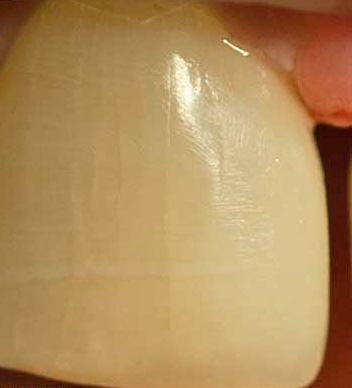 I prodotti molto caldi e freddi contribuiscono alla comparsa di microcricche nello smalto dei denti.