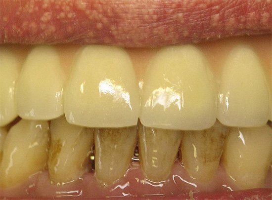 Denti gialli del fumatore