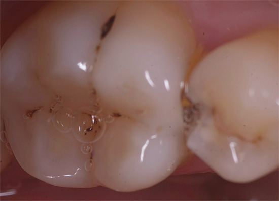 Lo smalto profondamente pigmentato può essere rimosso solo dal dentista, seguito dal riempimento dei denti.
