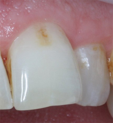 La foto mostra un esempio di un dente con carie iniziale prima del trattamento.