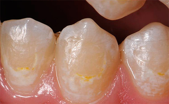 La foto mostra un esempio di carie iniziale: lo smalto dei denti è diventato bianco e ha iniziato a pigmentare.