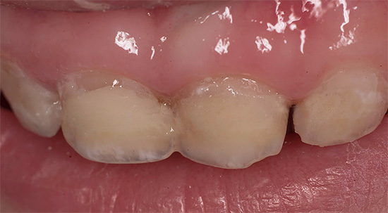 È necessario prendere misure per proteggere dalla carie dall'aspetto del primo dente da latte, senza aspettare fino a quando non inizia la sua distruzione ...