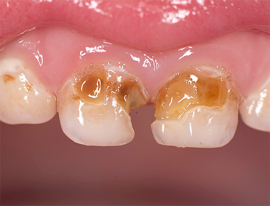 I seguenti metodi di protezione dei denti saranno particolarmente utili per coloro che hanno già lesioni cariose e che vogliono fermare il loro sviluppo.