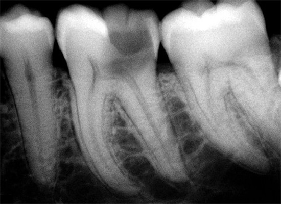 Radiografia di un dente malato: dentina e polpa sono visibili