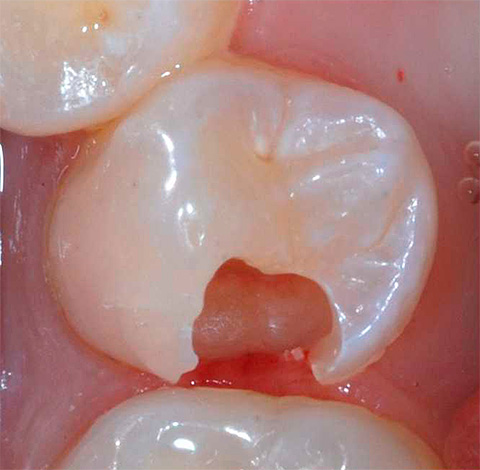 Foto del dente prima del trattamento