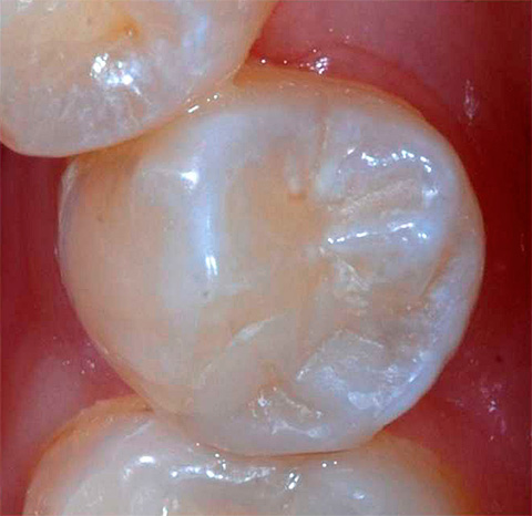 E questa è una foto di un dente con un sigillo già installato