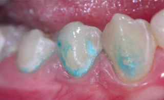 La colorazione persistente dello smalto dei denti con il blu di metilene indica l'inizio della sua demineralizzazione