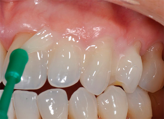 Le regolari procedure di rimineralizzazione riducono significativamente il rischio di carie e rappresentano un'eccellente misura preventiva.