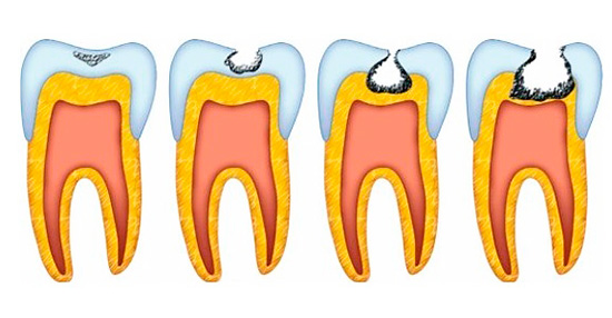 Le fasi della carie: è chiaro che la dentina del dente è interessata solo dopo una grave distruzione dello smalto
