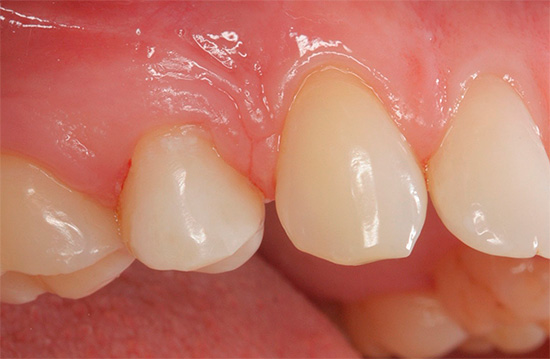 Se sembra anche che non tutto sia così male con i denti, ma senti dolore da caldo o freddo - forse stiamo parlando della carie della dentina