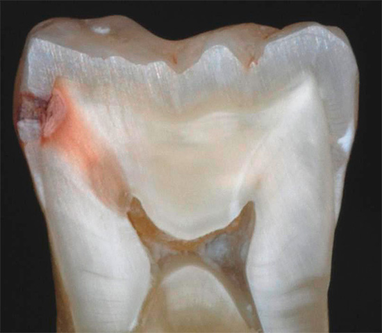 Sull'incisione di un dente affetto da carie, si può vedere chiaramente che l'infezione è penetrata in profondità nella dentina, fino alla polpa stessa