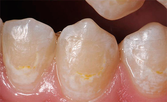 Se la carie è solo nella fase iniziale di sviluppo e interessa solo lo smalto dei denti, il trattamento può essere effettuato con metodi conservativi.