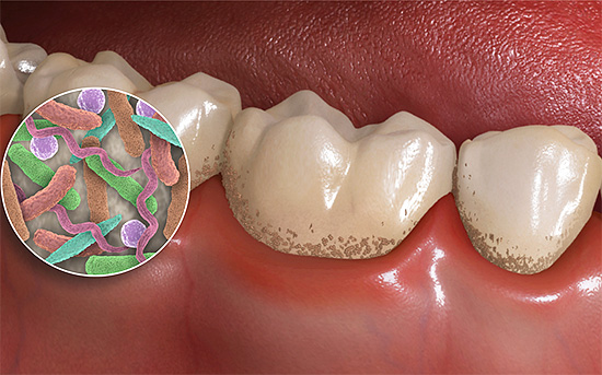 I batteri nella placca formano acidi organici, che contribuiscono alla demineralizzazione dello smalto dei denti.