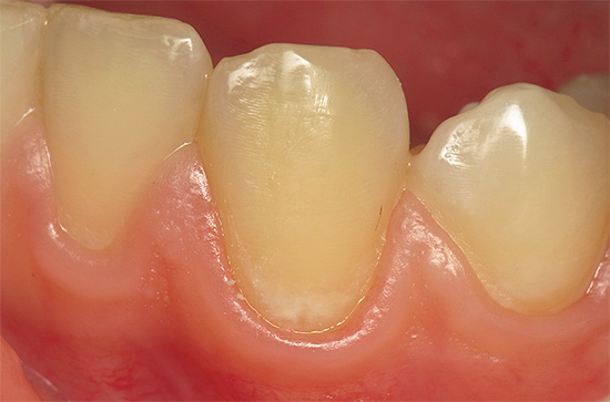 Molti non prestano attenzione alla comparsa di una macchia bianca o di gesso sul dente, sebbene questo sia un segnale allarmante dell'insorgenza della carie di smalto.