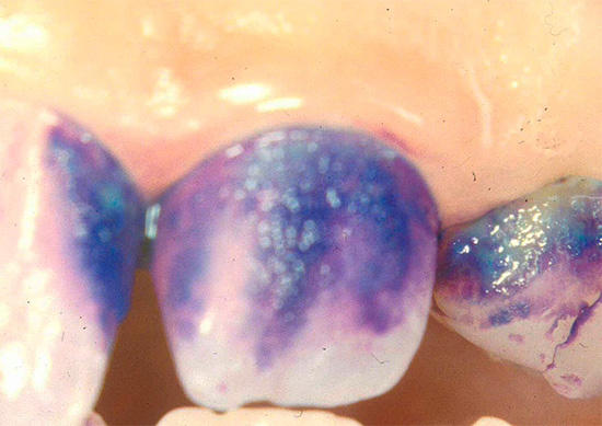 La carie porta al fatto che lo smalto dei denti diventa poroso e facilmente colorato con vari coloranti organici, in particolare il blu di metilene.