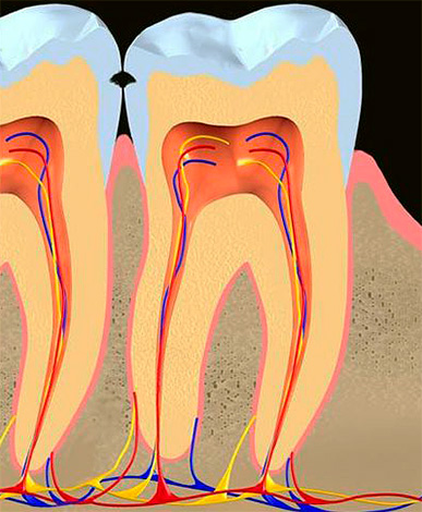 L'immagine mostra danni allo smalto durante la carie sulla superficie di contatto dei denti