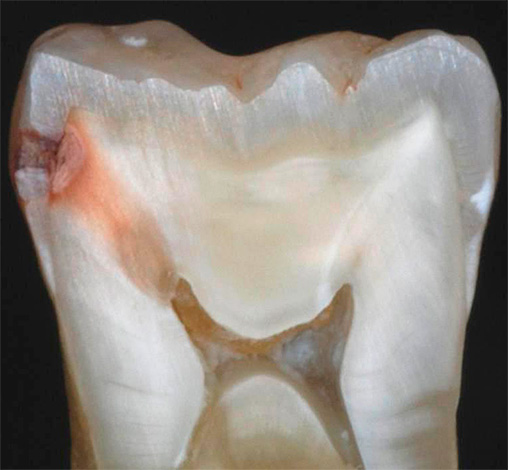 Ed è così che appare un vero dente nel contesto: è chiaro che non solo lo smalto, ma anche la dentina in tutto lo spessore è influenzata dalla carie