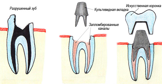 Um exemplo de restauração dentária usando uma aba e coroa cultivadas
