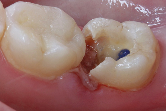 Fotografia de um dente deteriorado antes da deterioração
