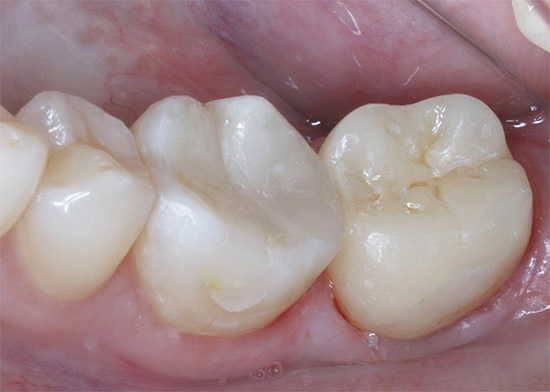 E parece um dente já selado após o tratamento.