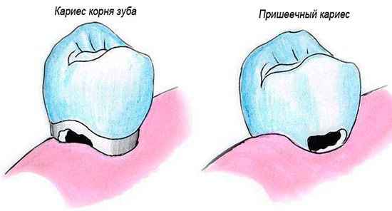 A cárie cervical e a cárie radicular são ligeiramente diferentes no lugar de sua luxação no dente