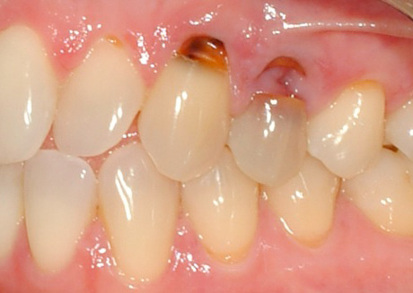 A foto mostra um exemplo de cárie cervical