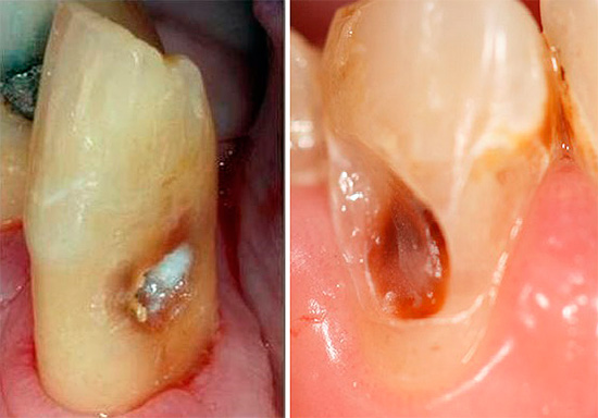 Muitas vezes, a destruição começa com a zona cervical e depois se transforma em cárie radicular.