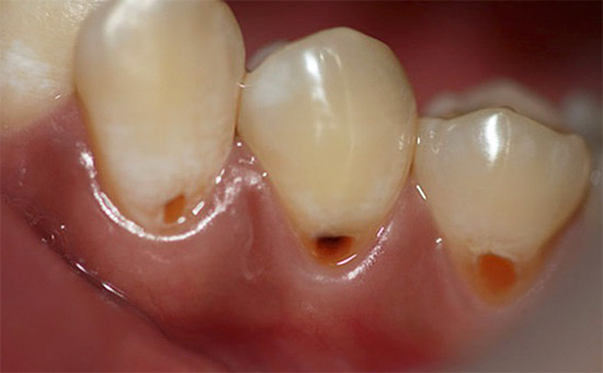 O processo carioso na raiz do dente pode passar despercebido por um longo tempo, até se manifestar como defeitos cervicais