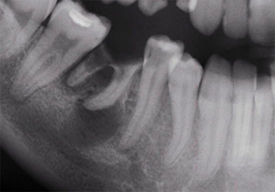 Raio-X dos dentes: na raiz de um deles é visível uma área de escurecimento